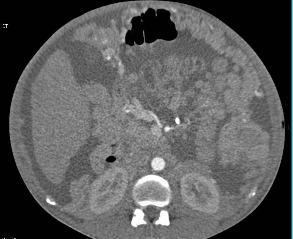 Melanoma with Carcinomatosis - CTisus CT Scan