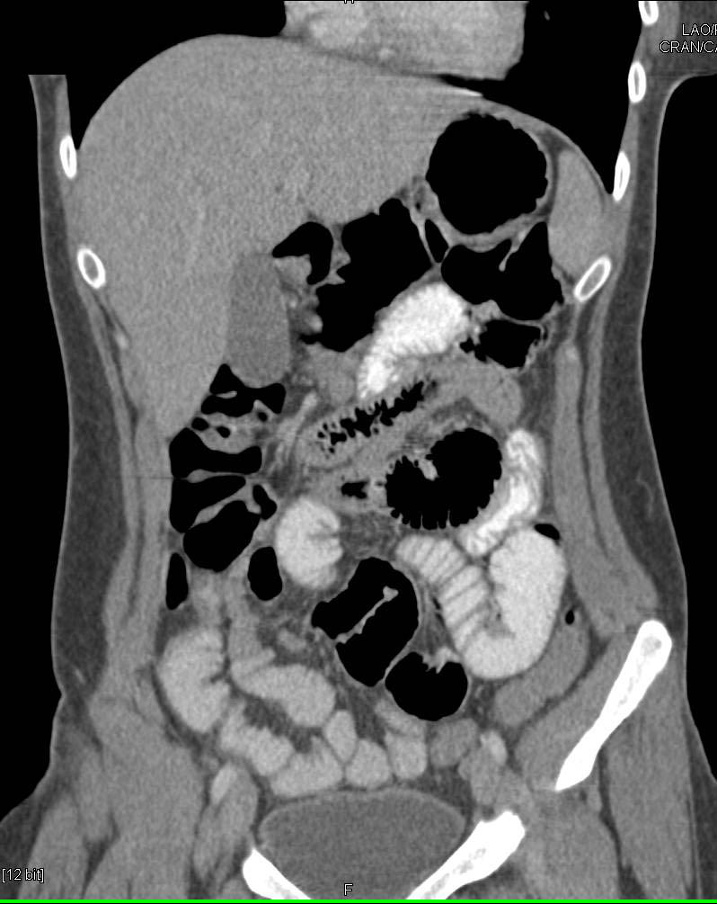 Small Bowel Enteritis - CTisus CT Scan