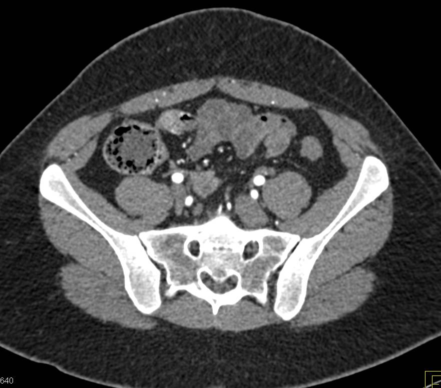 Adenocarcinoma (2 cm) Arises in the Terminal Ileum - CTisus CT Scan