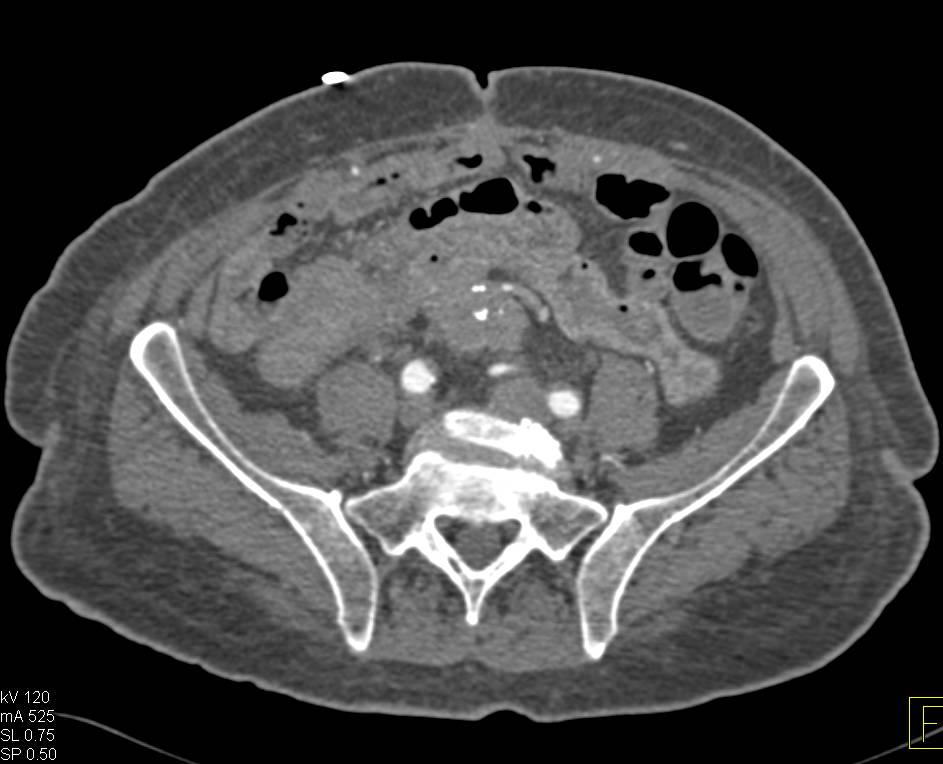 Carcinoid Tumor in the Root of the Mesentery - CTisus CT Scan