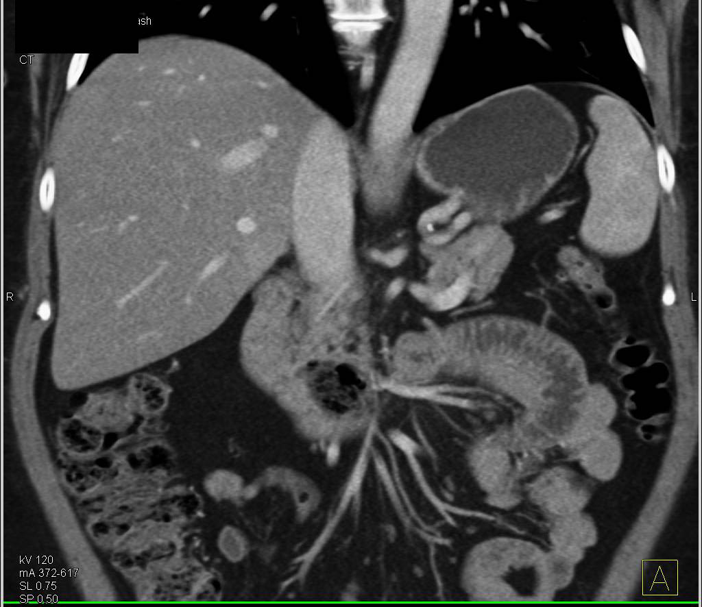 Duodenal Diverticulum Simulates a Pancreatic Abscess - CTisus CT Scan