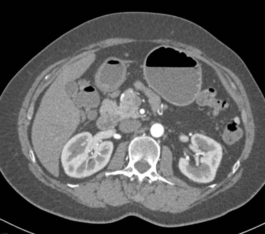 Subtle Adenocarcinoma in 2nd-3rd Portion of Duodenum - CTisus CT Scan