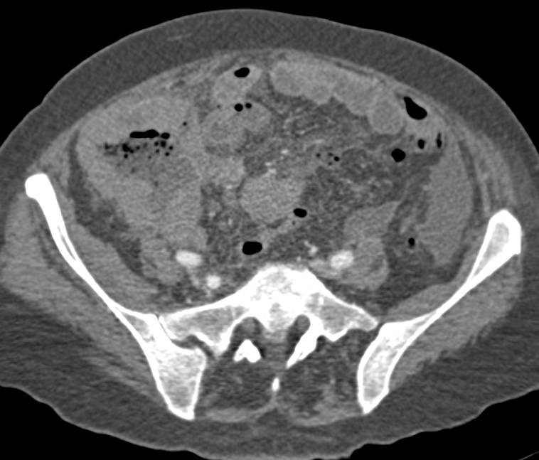 Perforated Ileal Carcinoma with Pneumoperitoneum - CTisus CT Scan