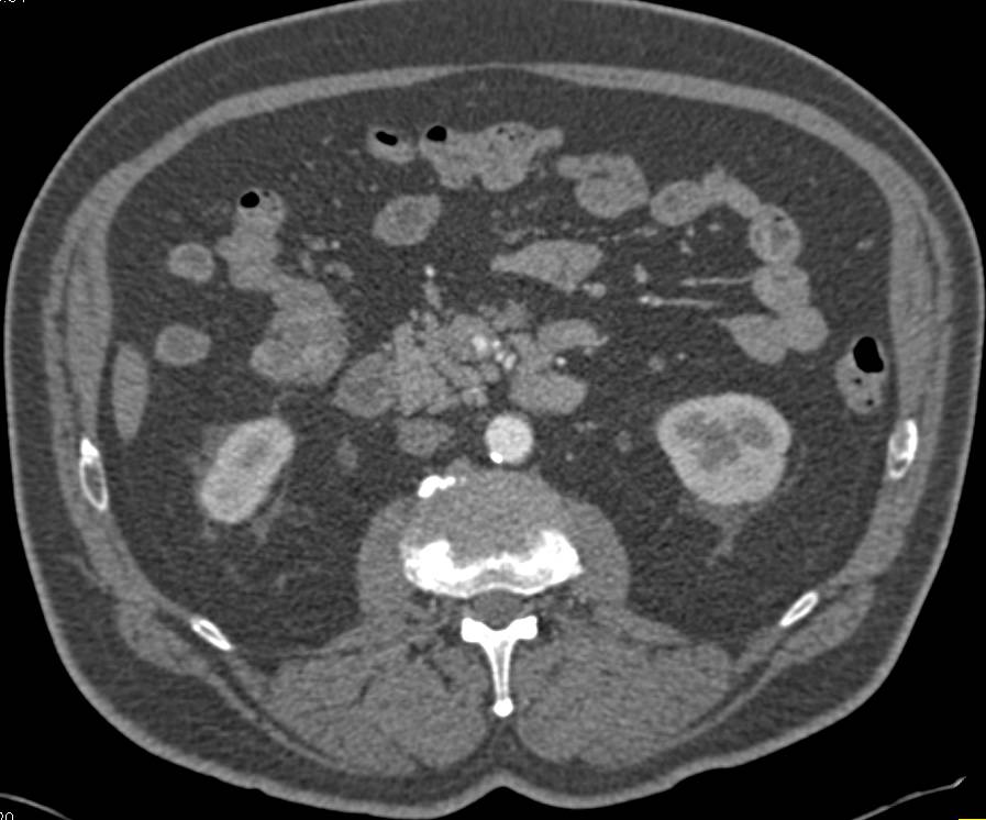 Carcinoid Tumor in the Root of the Mesentery with Superior Mesenteric Artery (SMA) and Superior Mesenteric Vein (SMV) Encasement - CTisus CT Scan