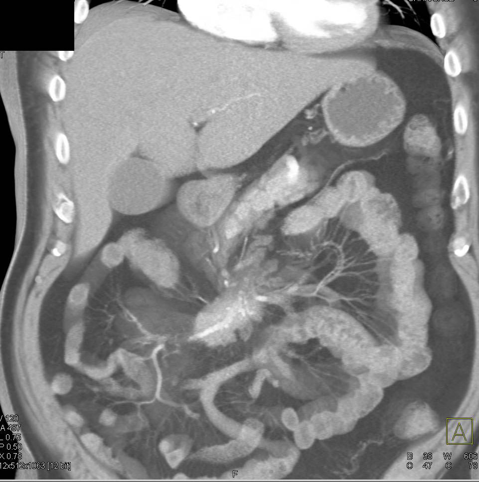 Carcinoid Tumor in the Root of the Mesentery with Superior Mesenteric Artery (SMA) and Superior Mesenteric Vein (SMV) Encasement - CTisus CT Scan