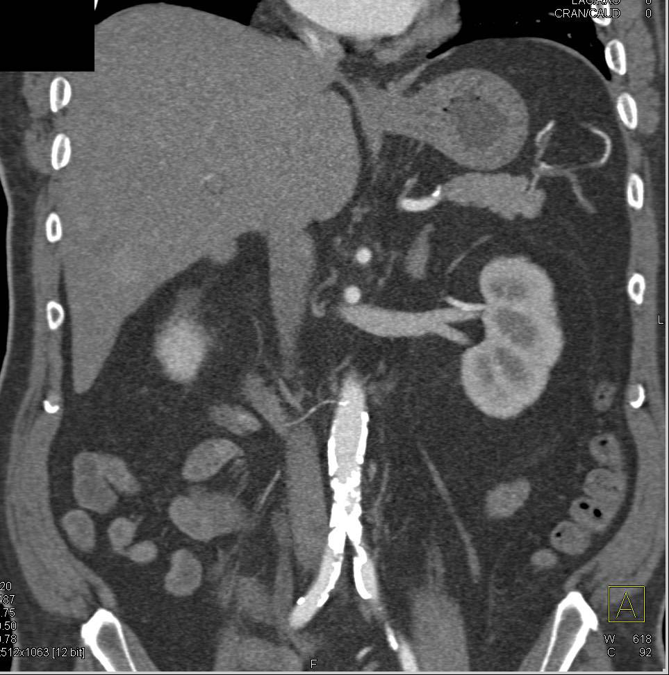 Carcinoid Tumor in the Root of the Mesentery with Superior Mesenteric ...