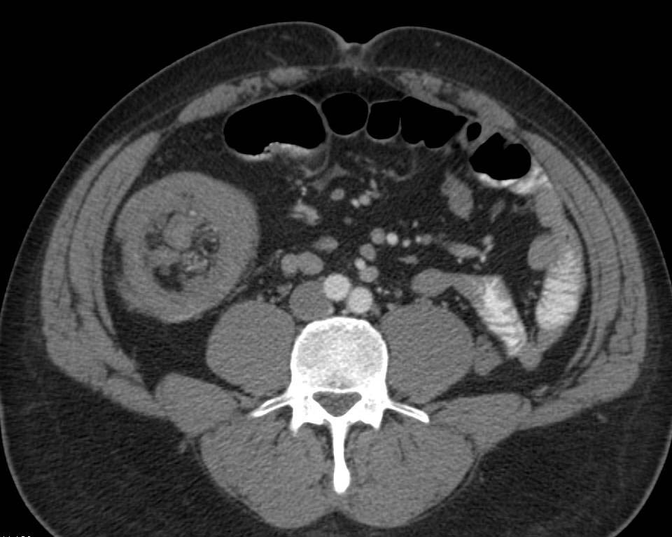 Lipoma of Ileum is Lead Point in the Ileo-colic Intussusception - CTisus CT Scan