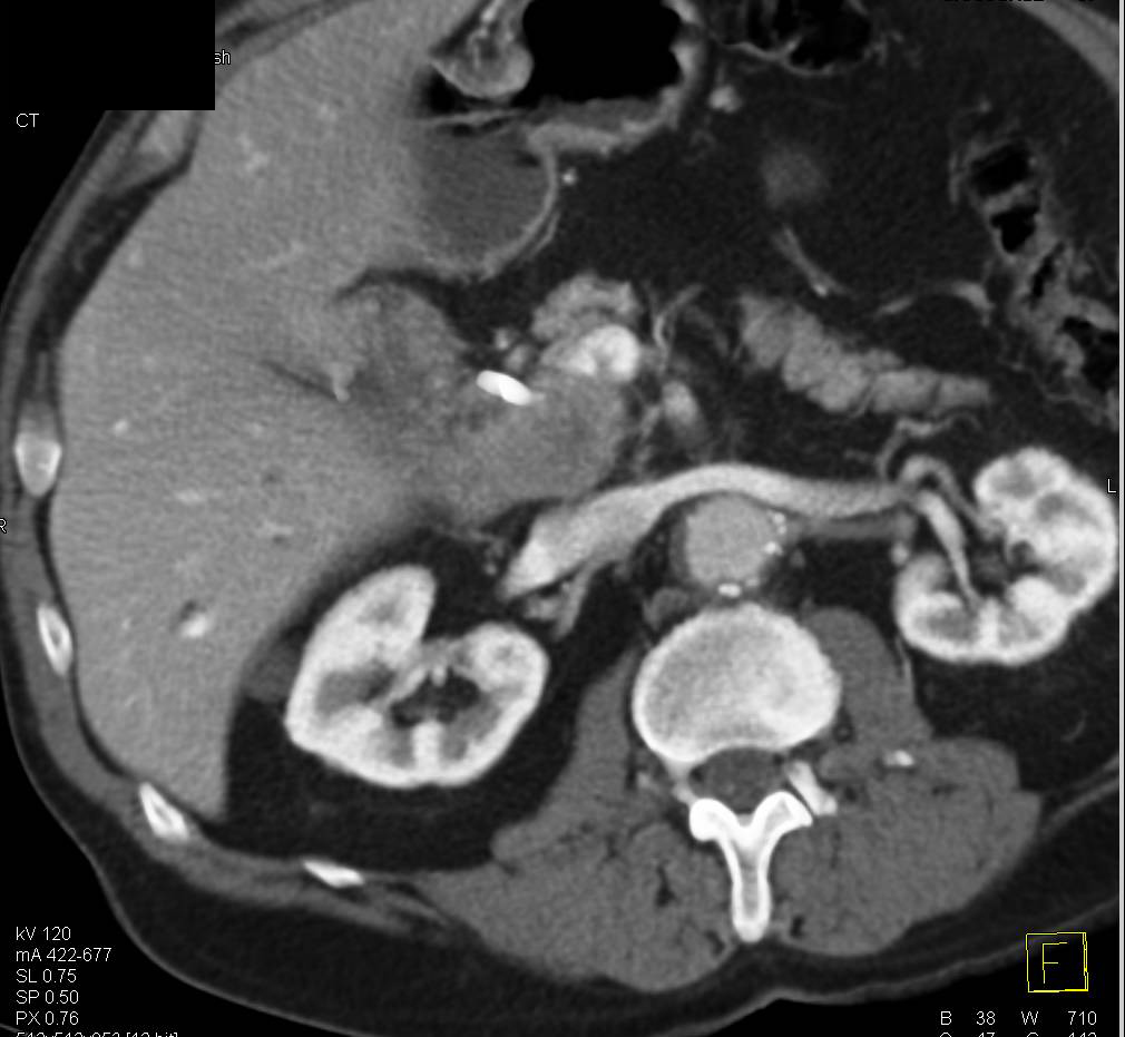 Duodenal Carcinoma with Portocaval Adenopathy - CTisus CT Scan