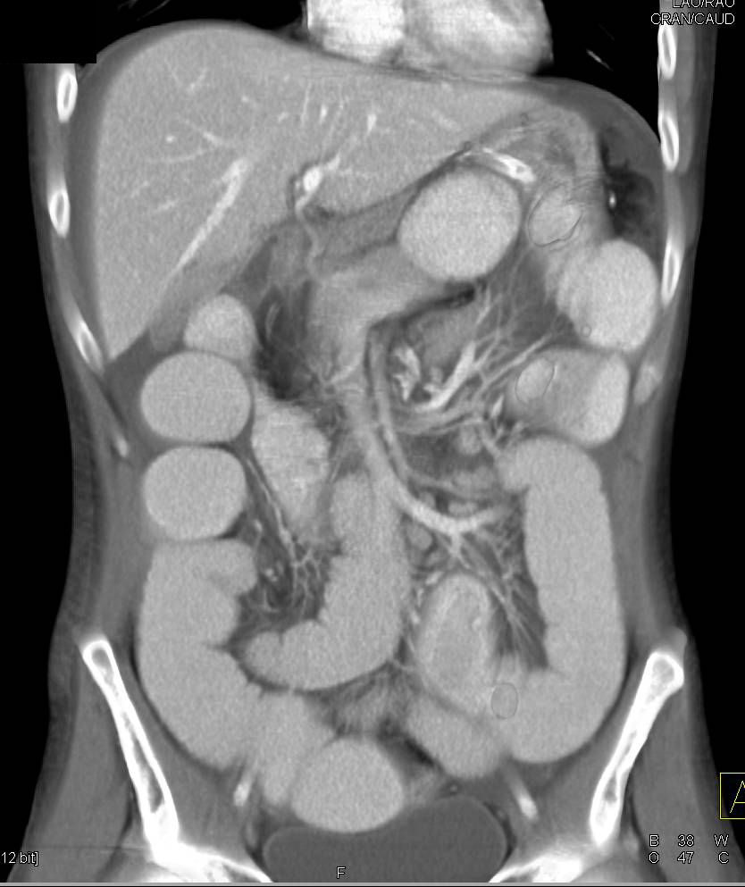 Pneumoperitoneum with Small Bowel Obstruction - CTisus CT Scan