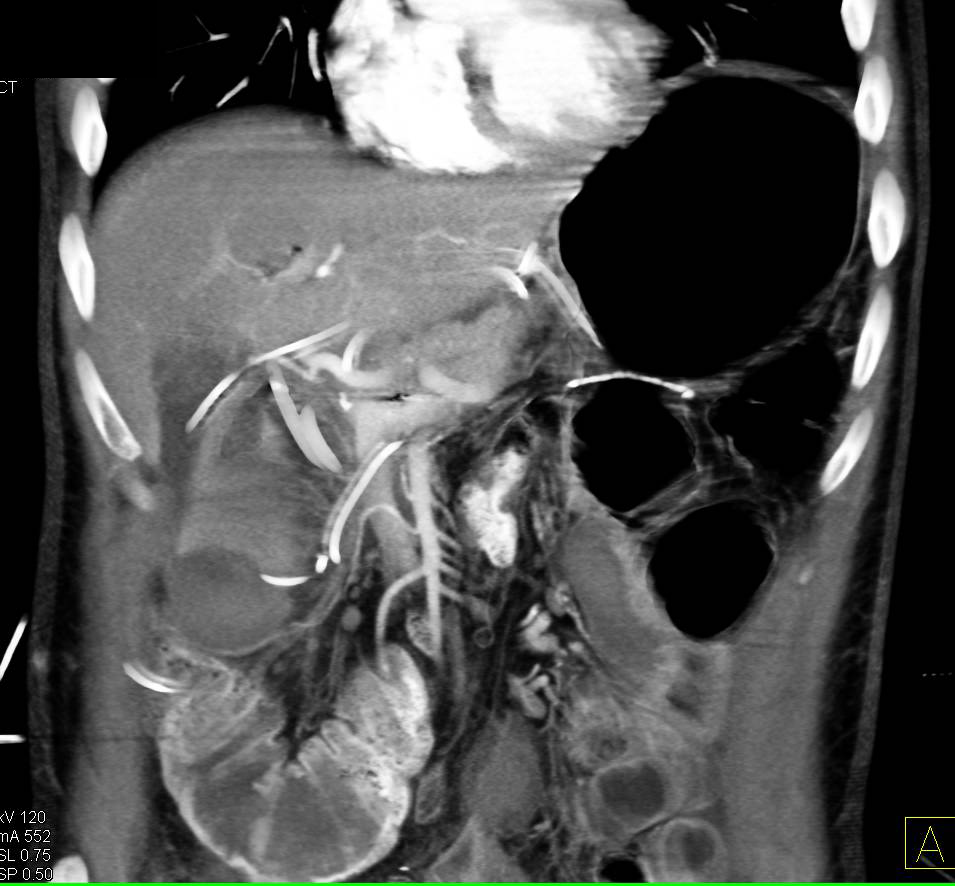 Small Bowel Obstruction Postop - CTisus CT Scan