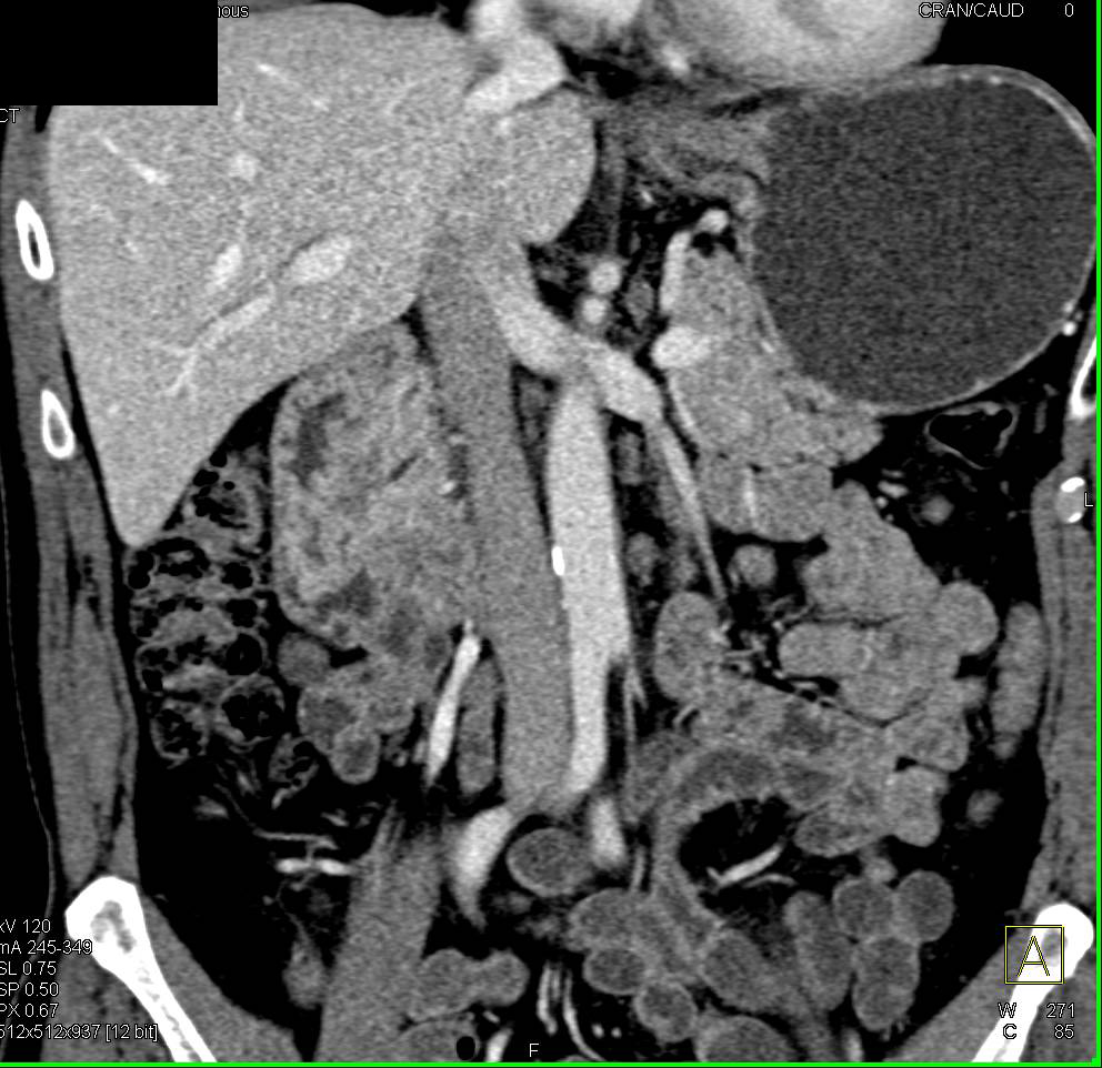 Villous Adenoma with Malignant Potential in the Duodenum - CTisus CT Scan