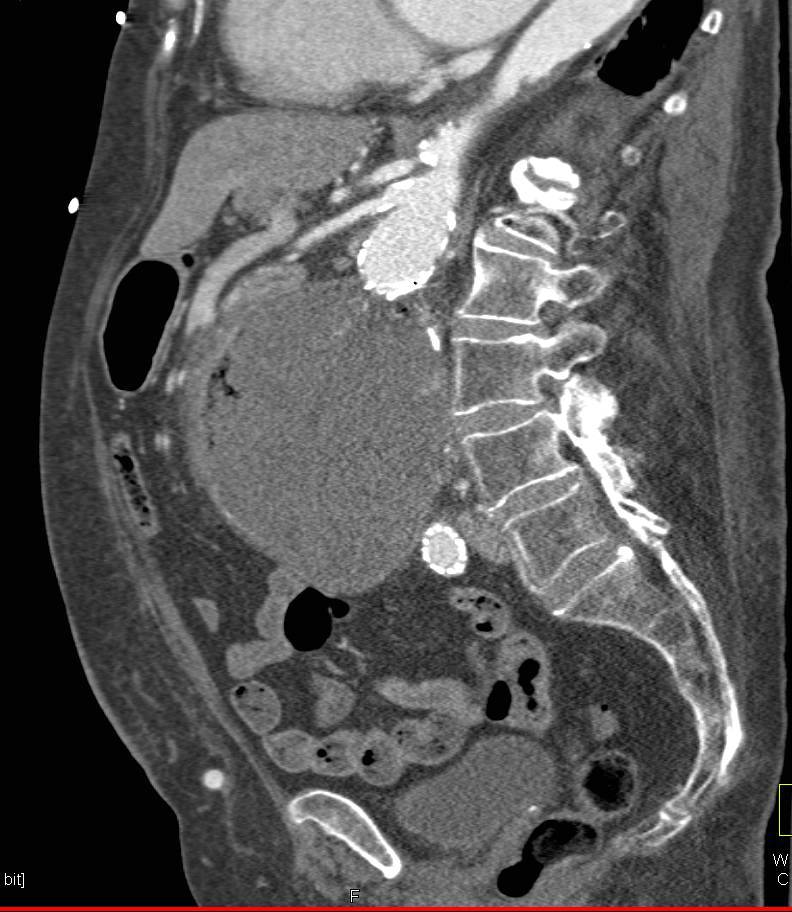 Aorto-enteric Fistulae - CTisus CT Scan