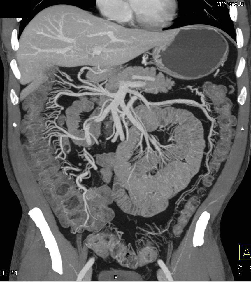 Lymphocytic Colitis with Nice Vasa Recta - CTisus CT Scan