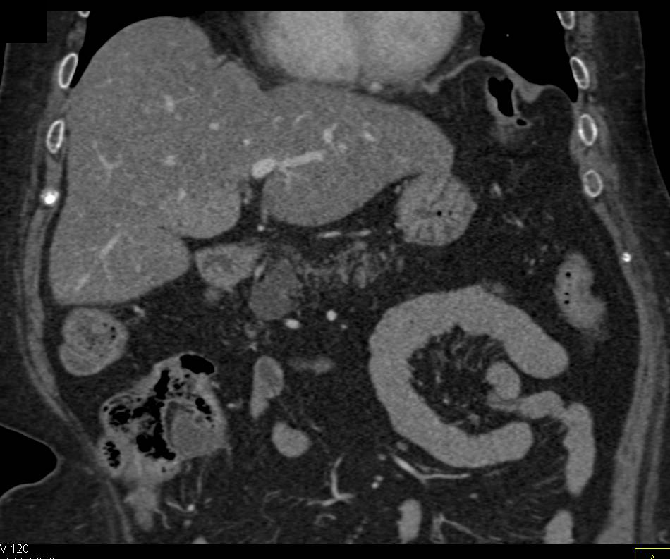 Carcinoid Tumor with Faint Calcifications - CTisus CT Scan