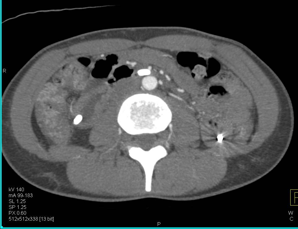 3D of Enteric Tube Extended to Ligament of Trietz - CTisus CT Scan