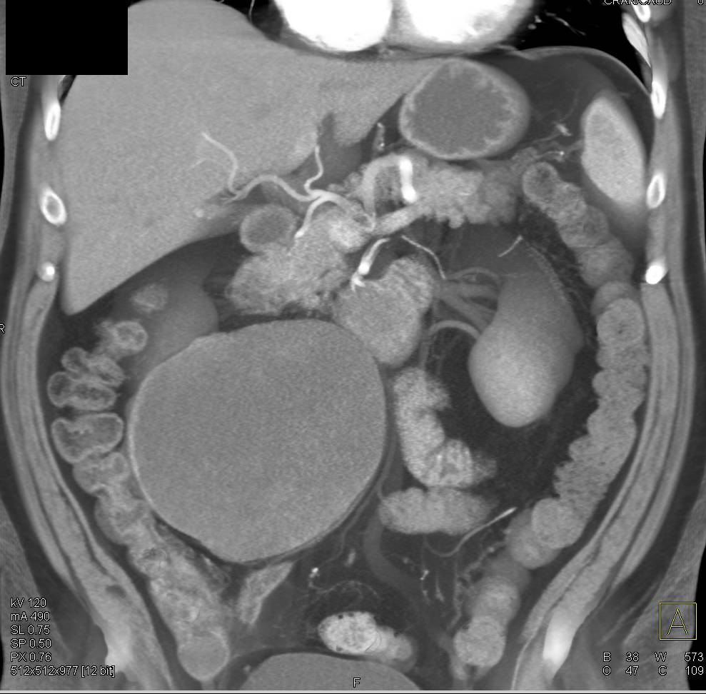 Mesenteric hematoma - CTisus CT Scan