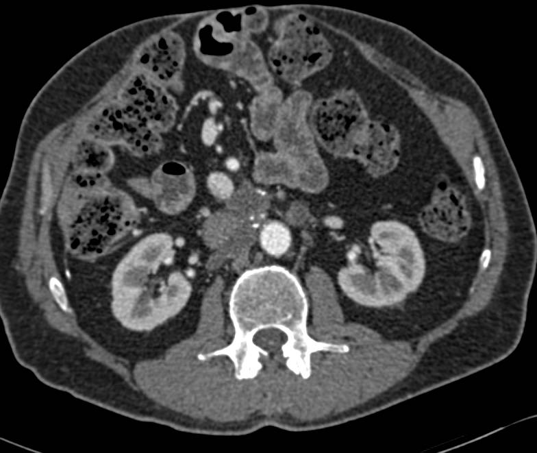 Midline Hernia - CTisus CT Scan