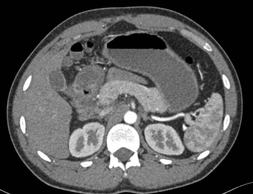 Duodenal Adenocarcinoma - CTisus CT Scan