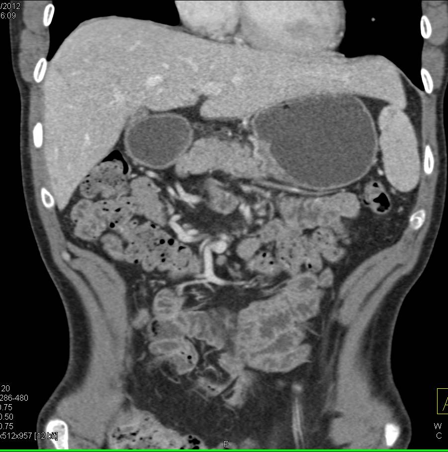 Normal Small Bowel and Mesentery - CTisus CT Scan