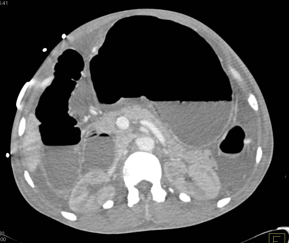 Ischemic Bowel with Pneumatosis and Ascites - CTisus CT Scan