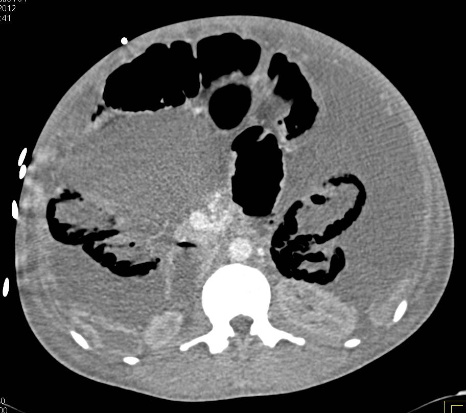 Ischemic Bowel with Portal Venous Air and Pneumatosis - CTisus CT Scan