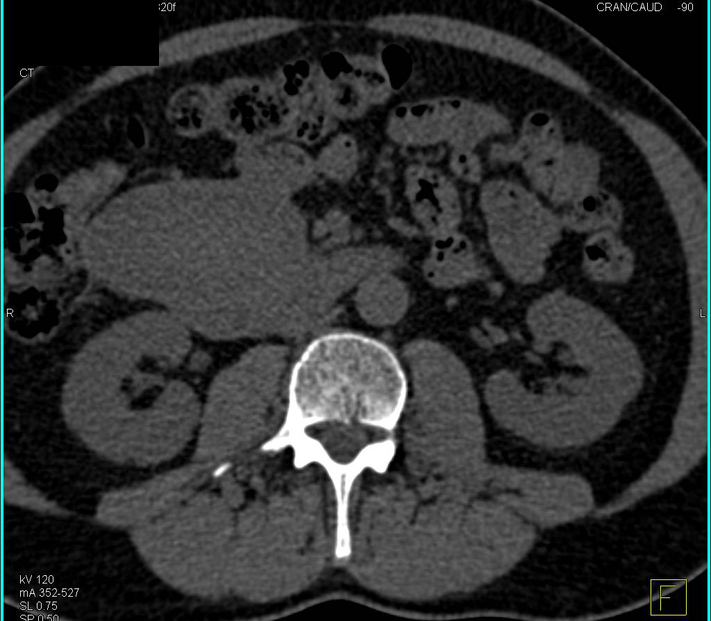 Paraduodenal Hematoma - CTisus CT Scan