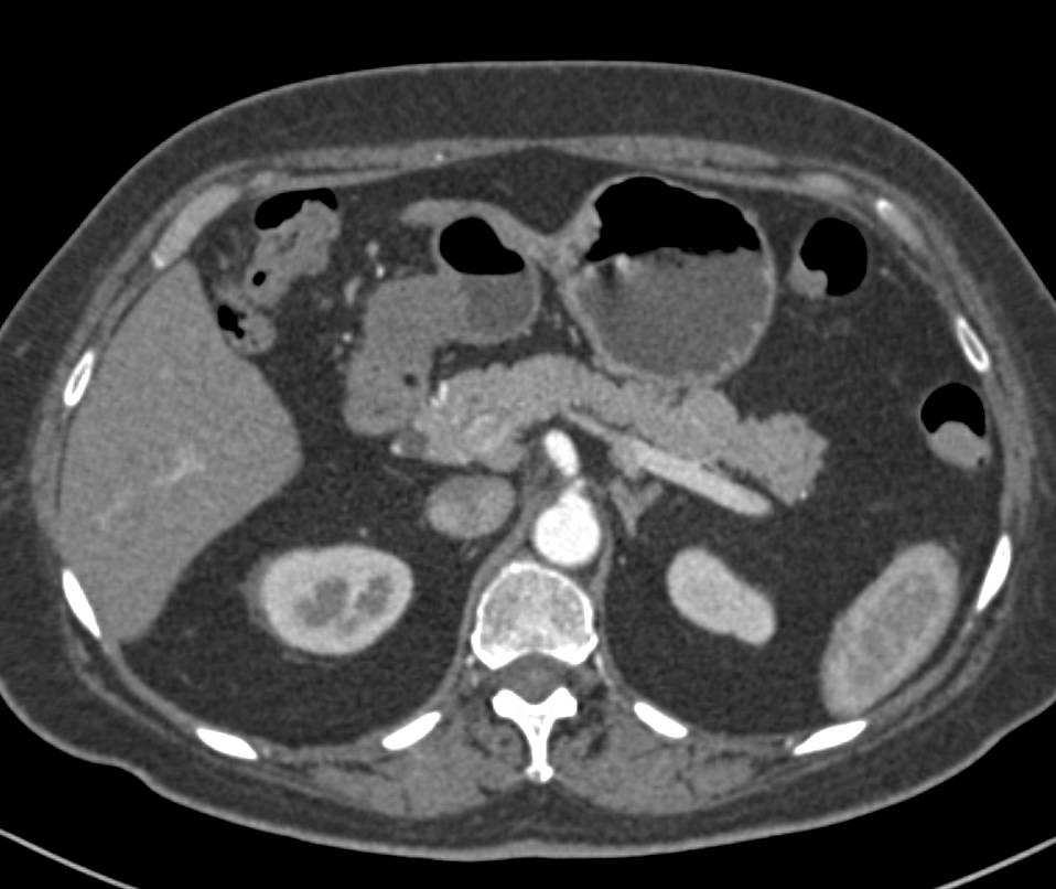 Duplication Cyst off Duodenum - CTisus CT Scan