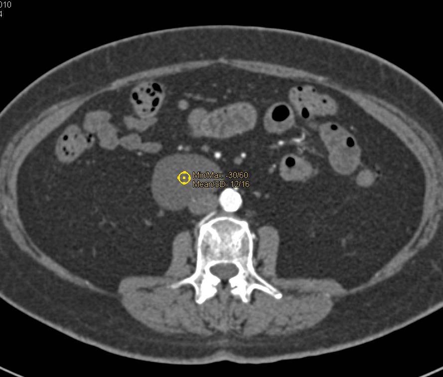 Mesenteric Cyst - CTisus CT Scan