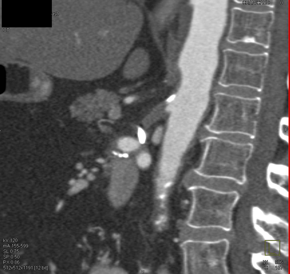 Occlusion of the Native Superior Mesenteric Artery (SMA) with Bypass Graft - CTisus CT Scan