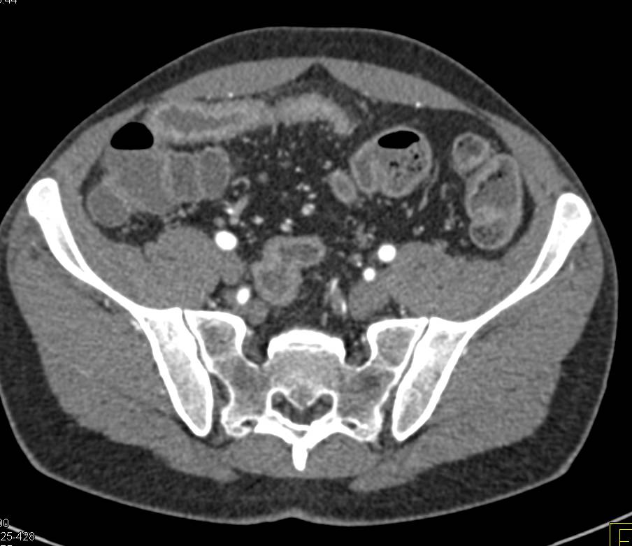 Crohn's Disease with Comb Sign - CTisus CT Scan