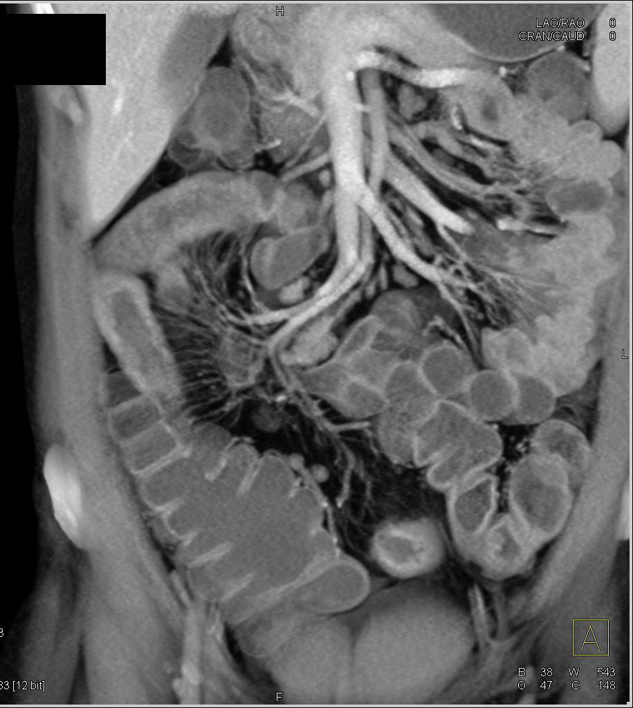 Crohn's Disease - CTisus CT Scan