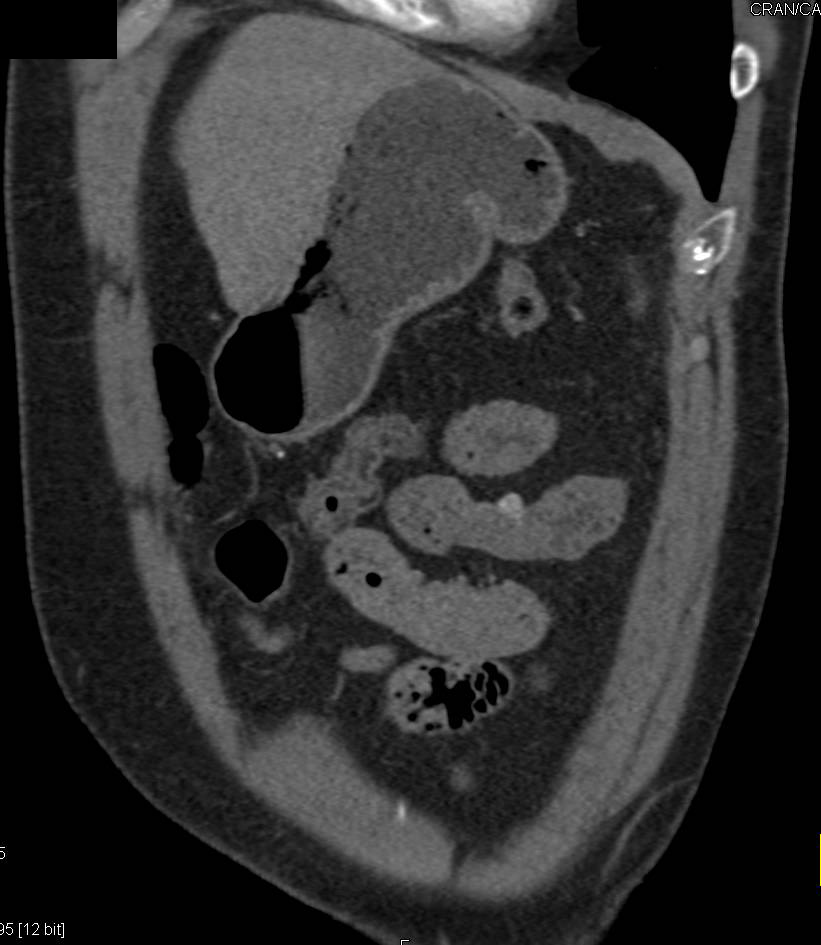 1 cm Small Bowel GIST Tumor in Patient Presenting with a Gastrointestinal (GI) Bleed - CTisus CT Scan