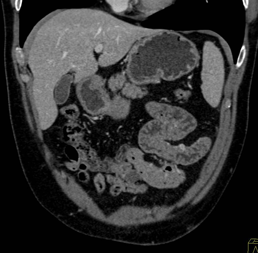 Small Carcinoid Tumor in the Small Bowel - CTisus CT Scan