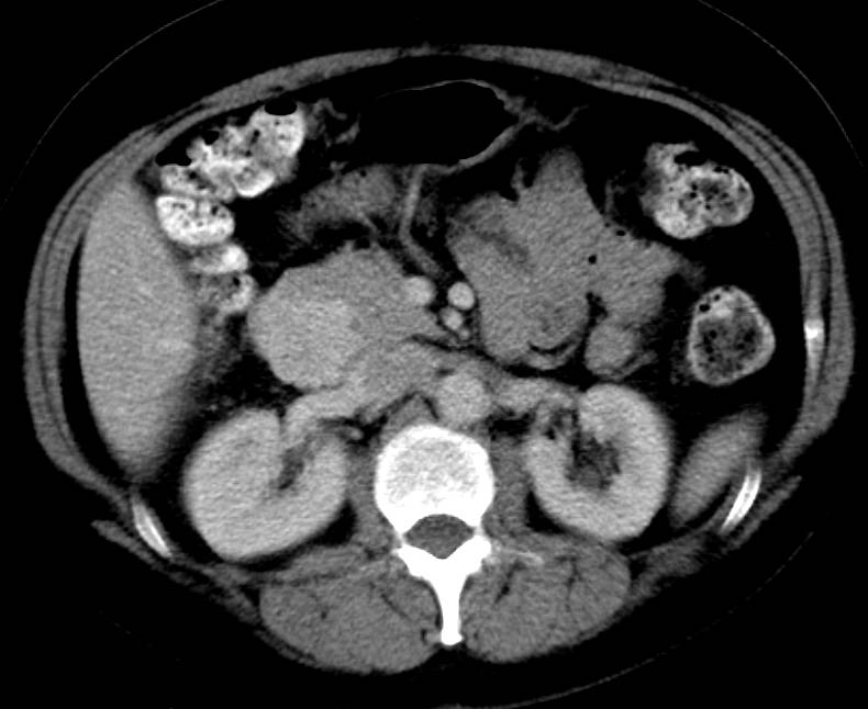 GIST Tumor Duodenum Looks lie a Neuroendocrine Tumor - CTisus CT Scan