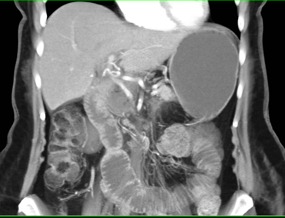 Obstructed Small Bowel at Anastomotic Site - CTisus CT Scan