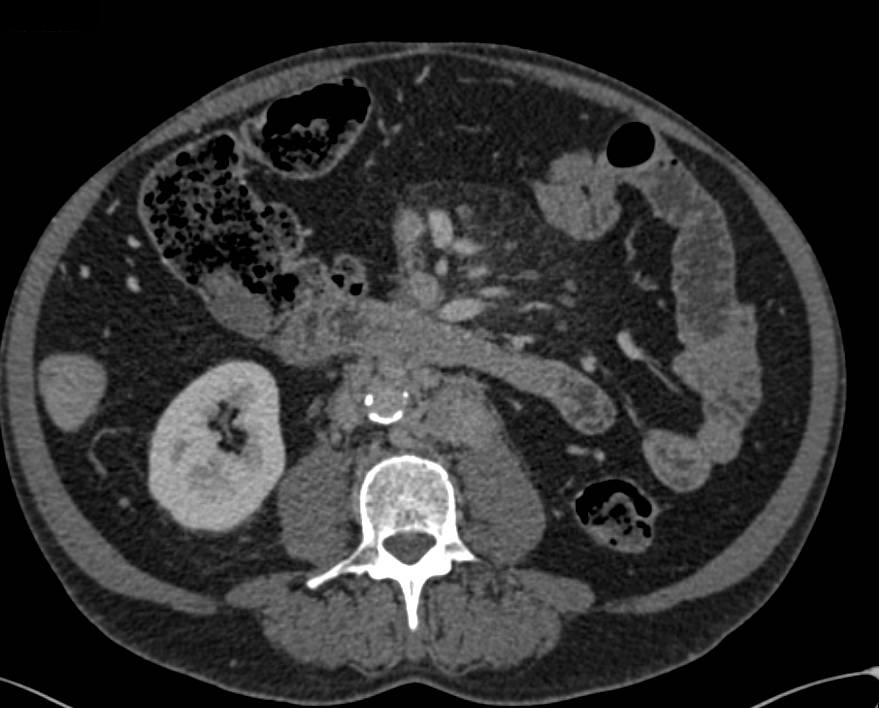 Lymphoma Infiltrates the Retroperitoneum with Adenopathy - CTisus CT Scan