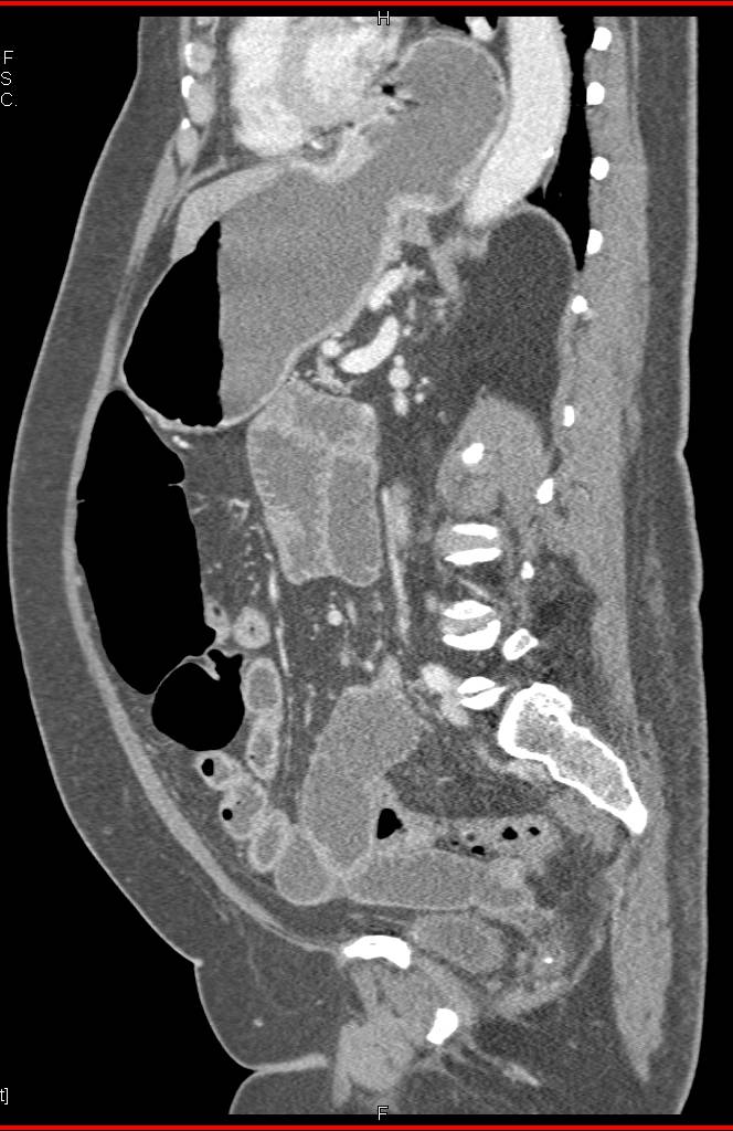 Partially Obstructed Small Bowel due to Inflammation in Crohn's Disease - CTisus CT Scan