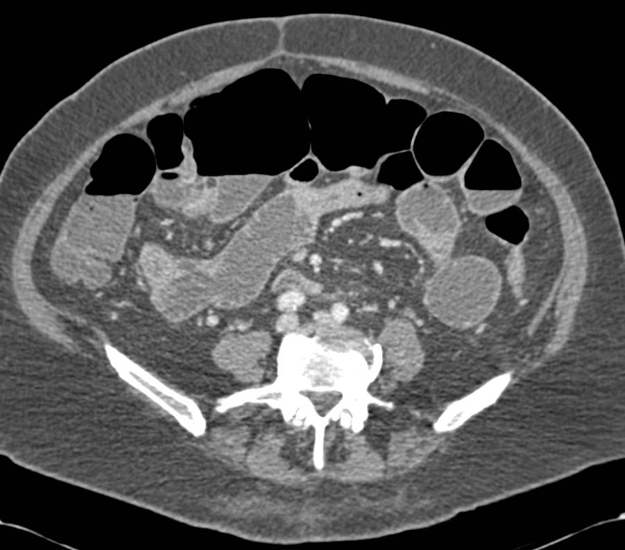 Small Bowel Obstruction (SBO) due to Subtle Distal Small Bowel Carcinoma - CTisus CT Scan