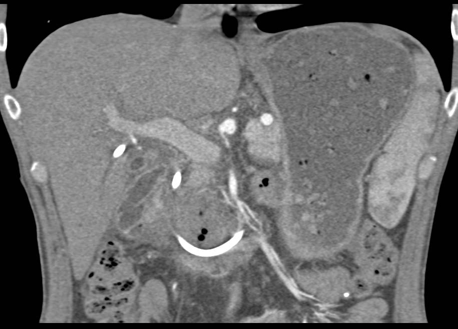 Necrotic Duodenal Carcinoma Simulates a Pancreatic Cancer - CTisus CT Scan