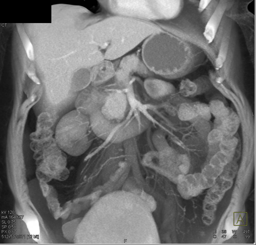 Carcinoid Tumor with Mass Near Head of Pancreas - CTisus CT Scan