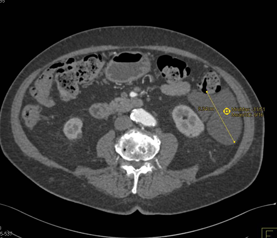 Lymphangioma Located Near Small Bowel - CTisus CT Scan