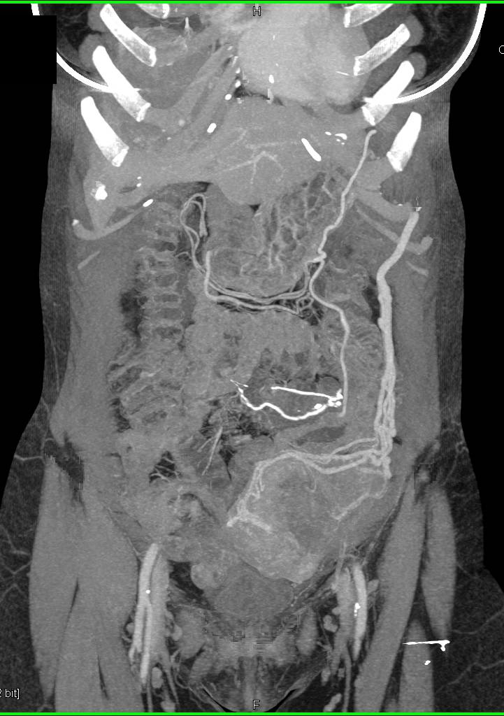 Small Bowel GIST Tumor Metastatic to the Liver - CTisus CT Scan