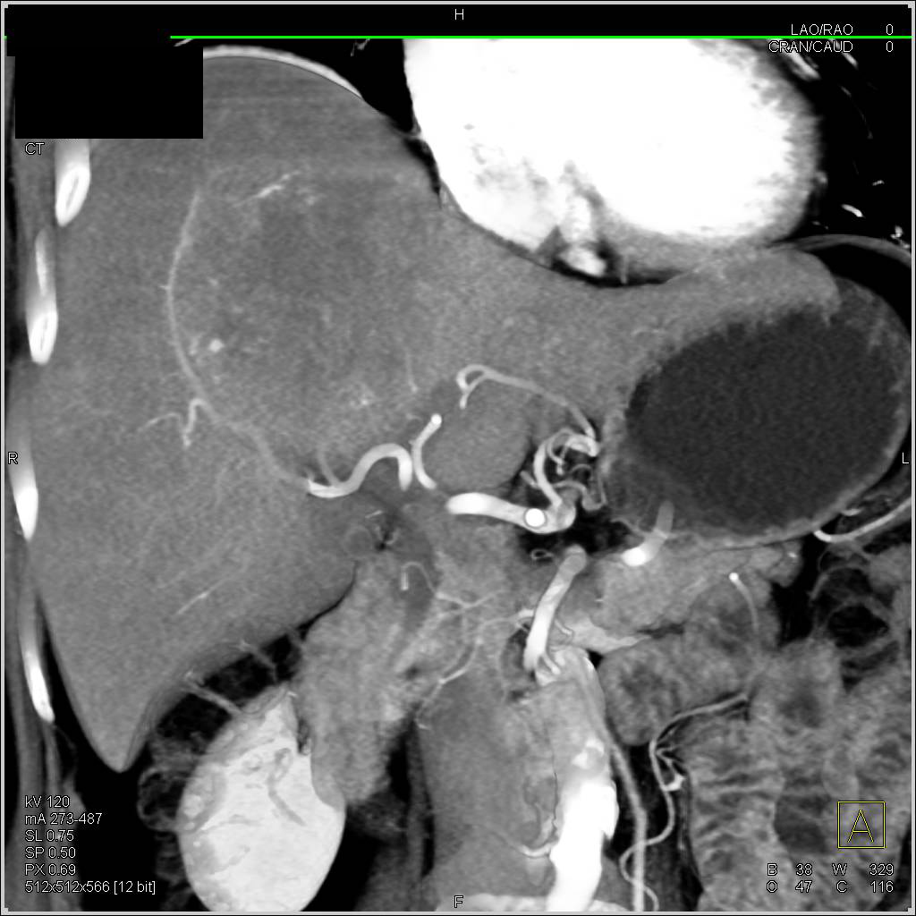 Small Bowel GIST Tumor Metastatic to the Liver - CTisus CT Scan