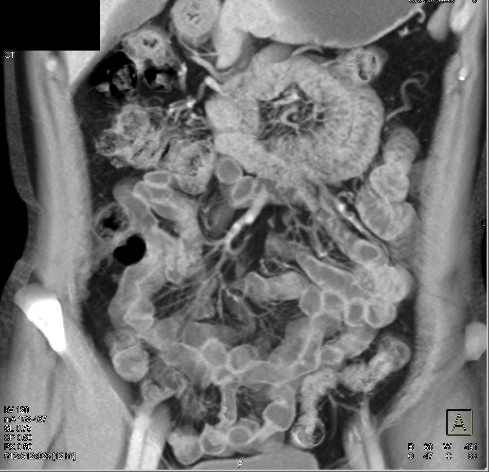 Dilated Small Bowel without Tumor - CTisus CT Scan