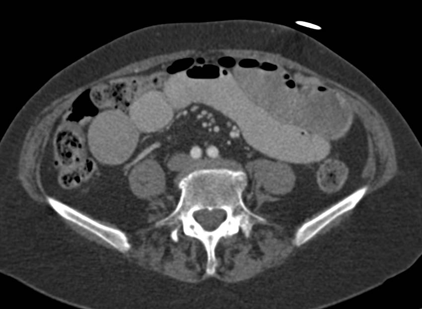 Small Bowel Obstruction due to Crohn's Disease - CTisus CT Scan