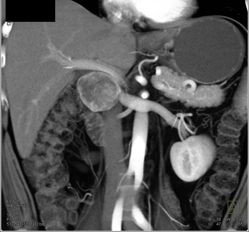 Duodenal GIST Tumor Simulates a Pancreatic Neuroendocrine Tumor - CTisus CT Scan