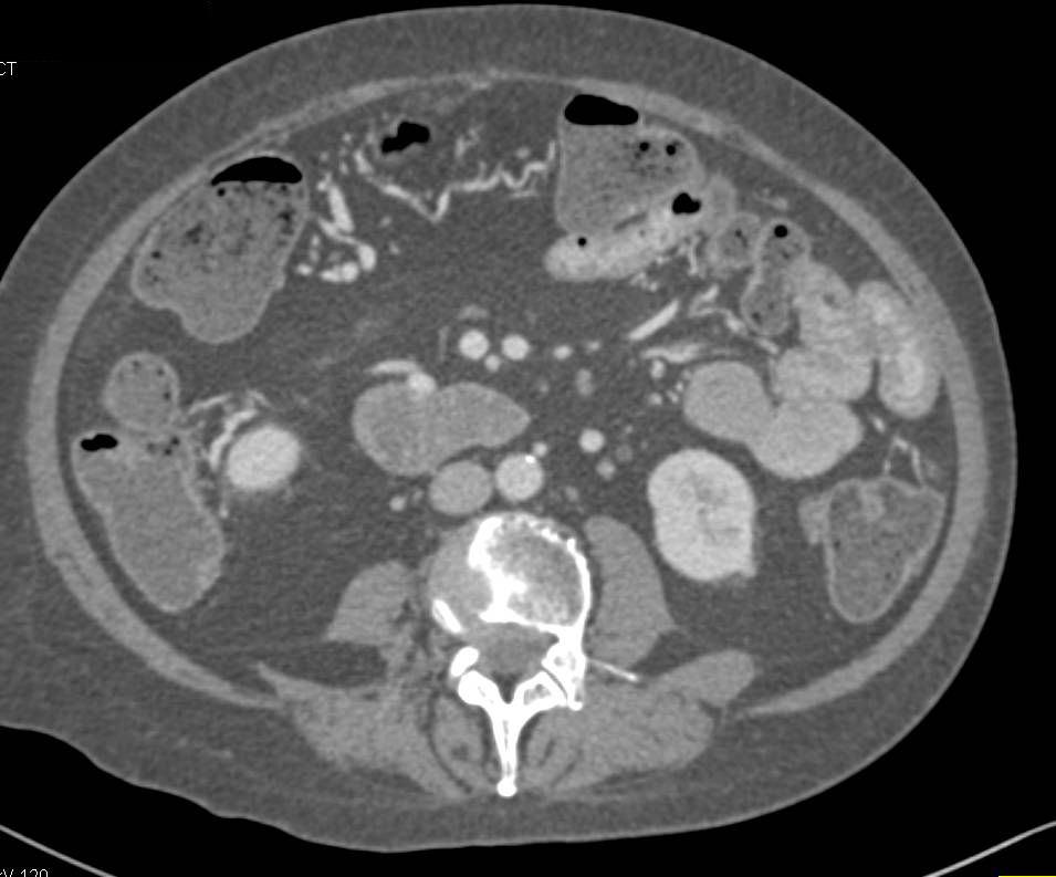 Use of Positive Oral Contrast Limits Evaluation of Bowel Wall Enhancement - CTisus CT Scan