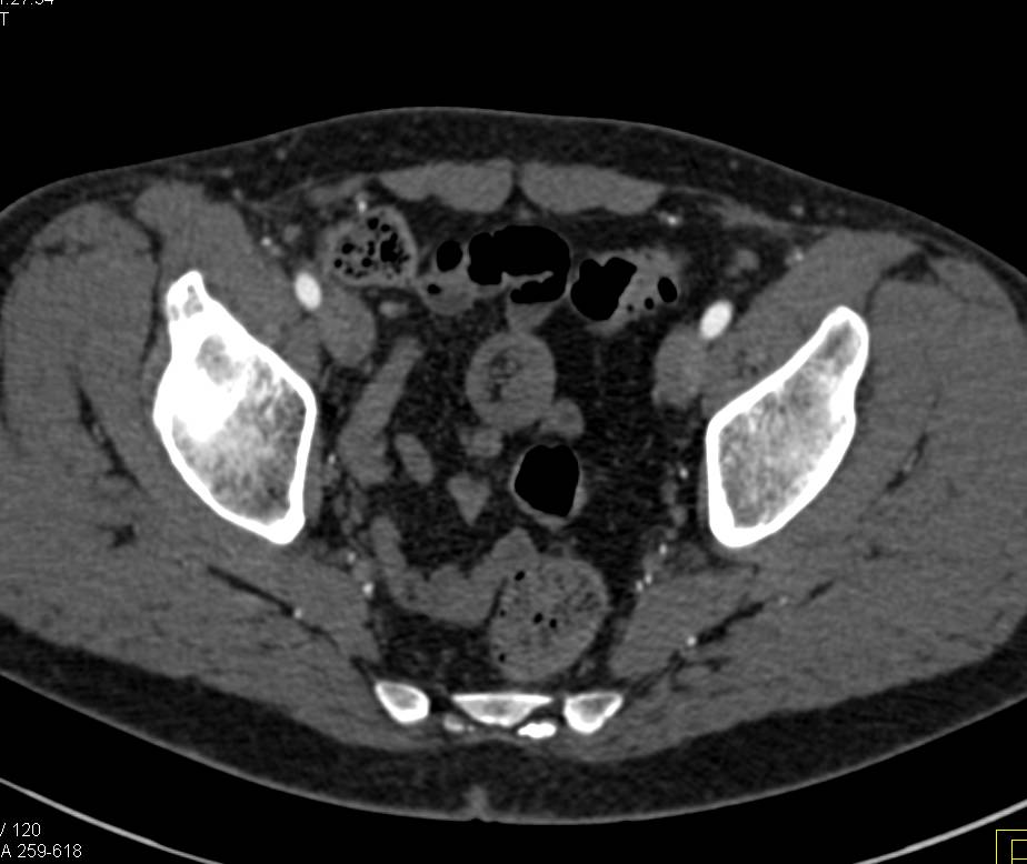 2 cm GIST Intussusception in Ileum - CTisus CT Scan