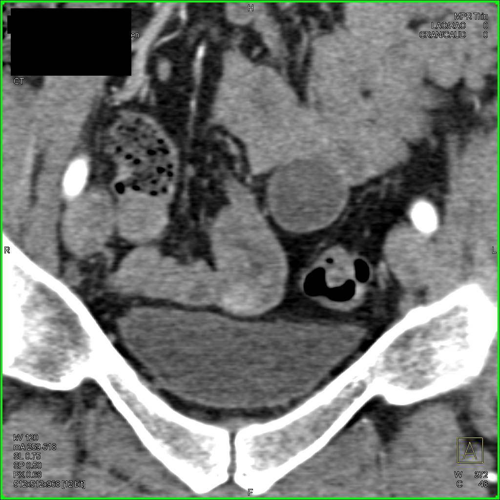 1 cm GIST Tumor with Intussusception distal ileum - CTisus CT Scan