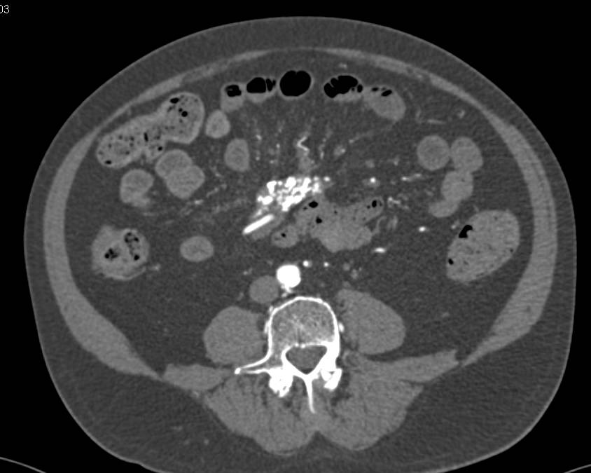 Carcinoid Tumor Root of Mesentery with Desmoplastic Reaction - CTisus CT Scan